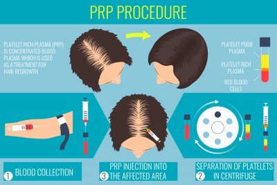 PRP HAIR TREATMENT
