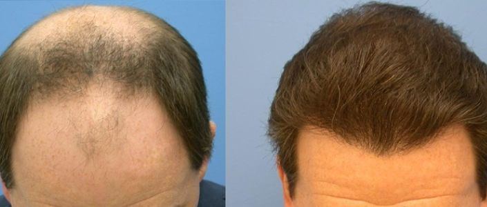 PRP For Hair Loss For Male | Dermcos