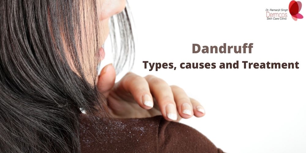 Different Types Of Dandruff, Treatment And Causes - Dermcos | Dermcos